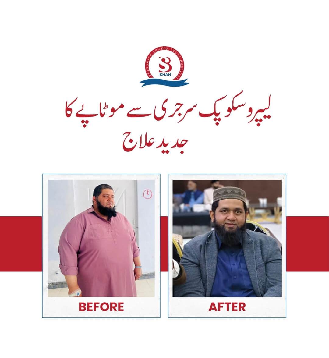 bariatric surgery before and after 1