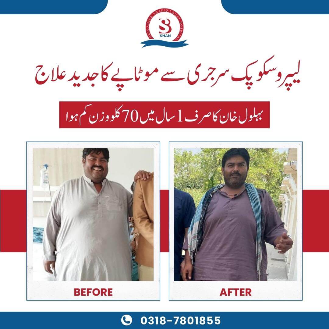 bariatric surgery before and after gallery