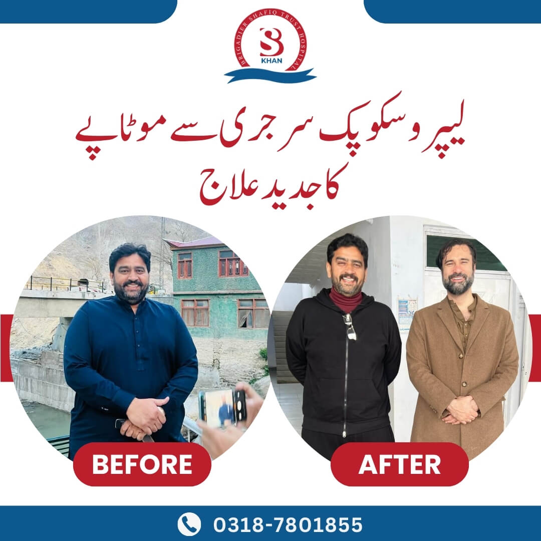 bariatric surgery before and after images