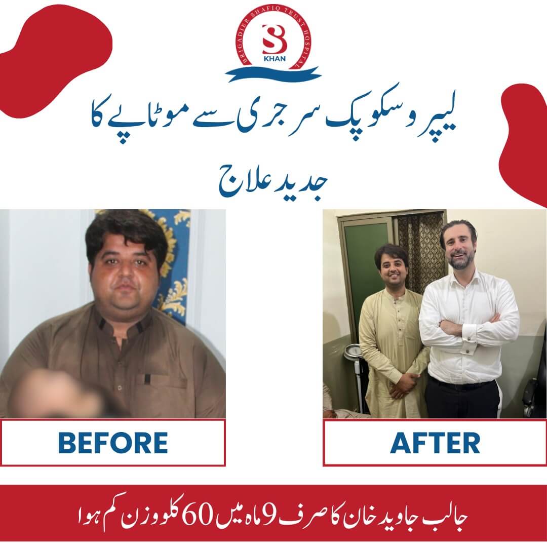 bariatric surgery before and after results