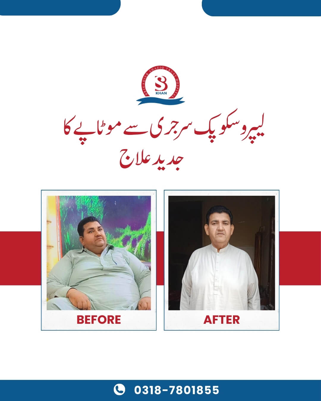 bariatric surgery before and after weight loss transformations