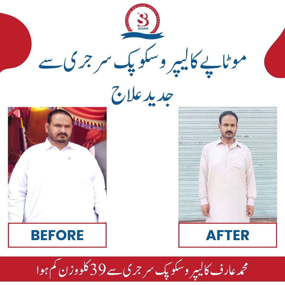 gastric bypass surgery before and after