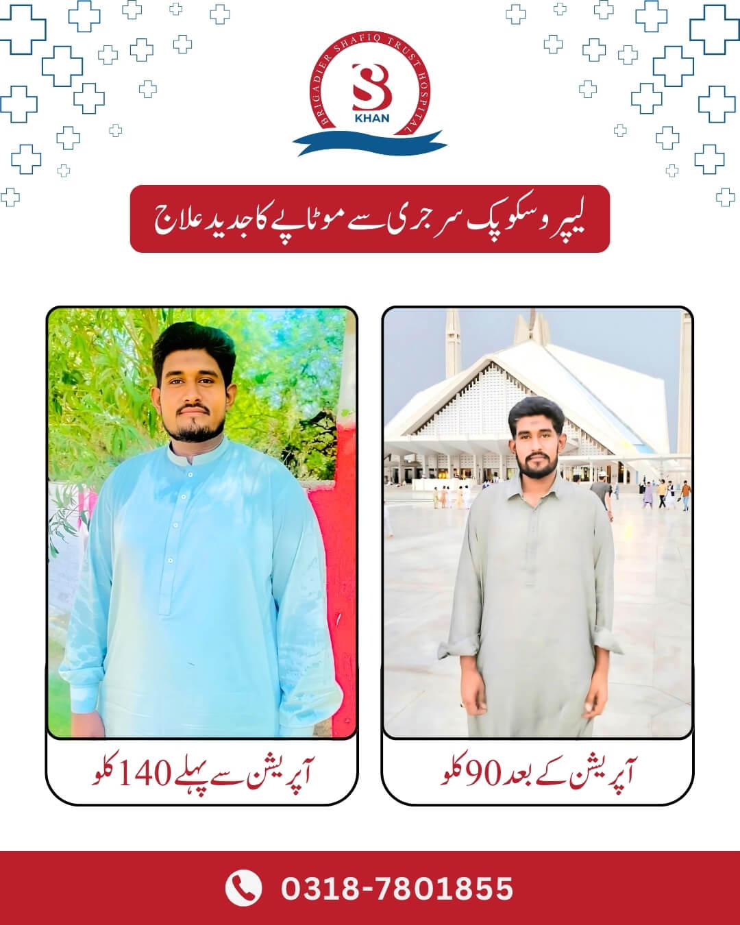 gastric sleeve surgery before and after