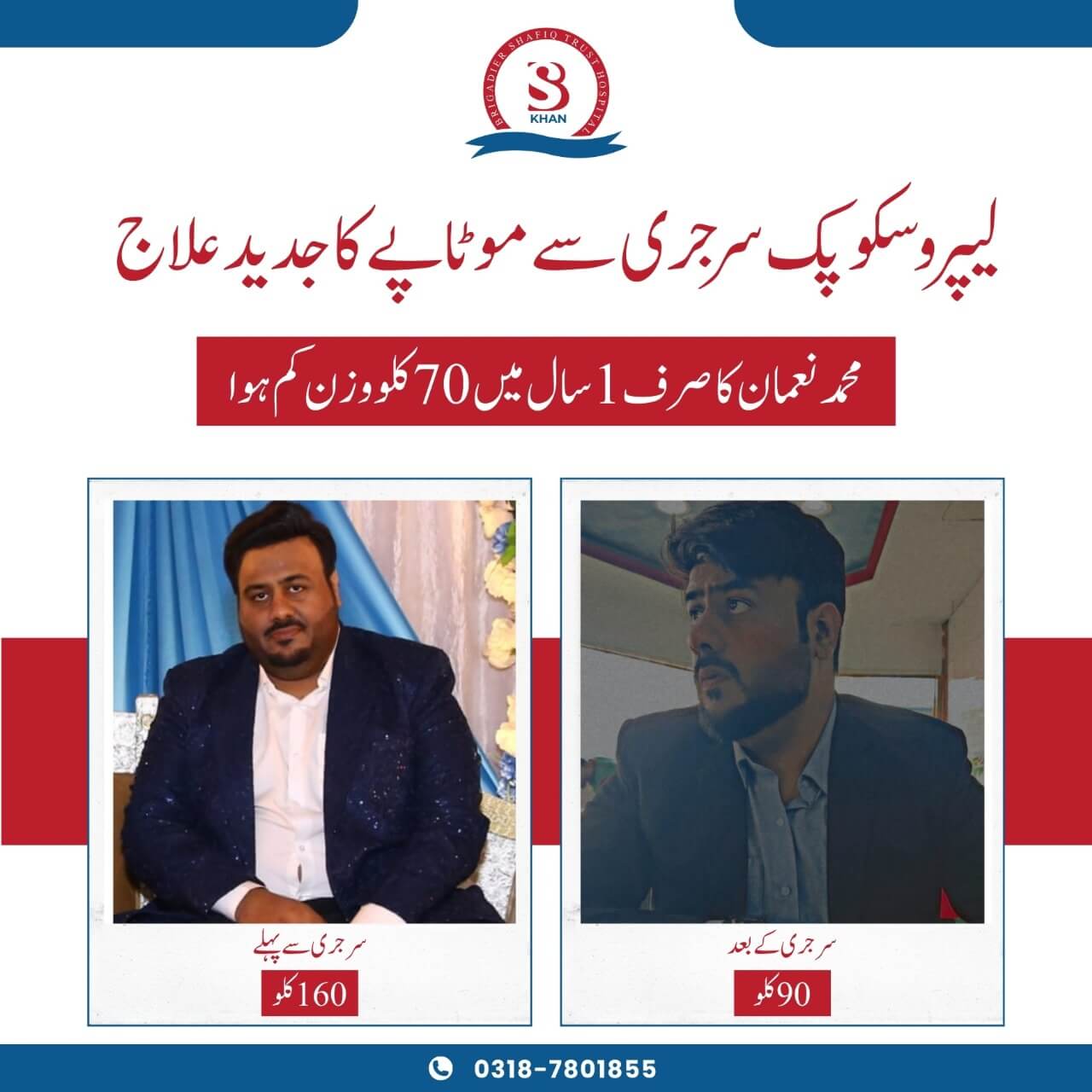 obesity surgery before and after