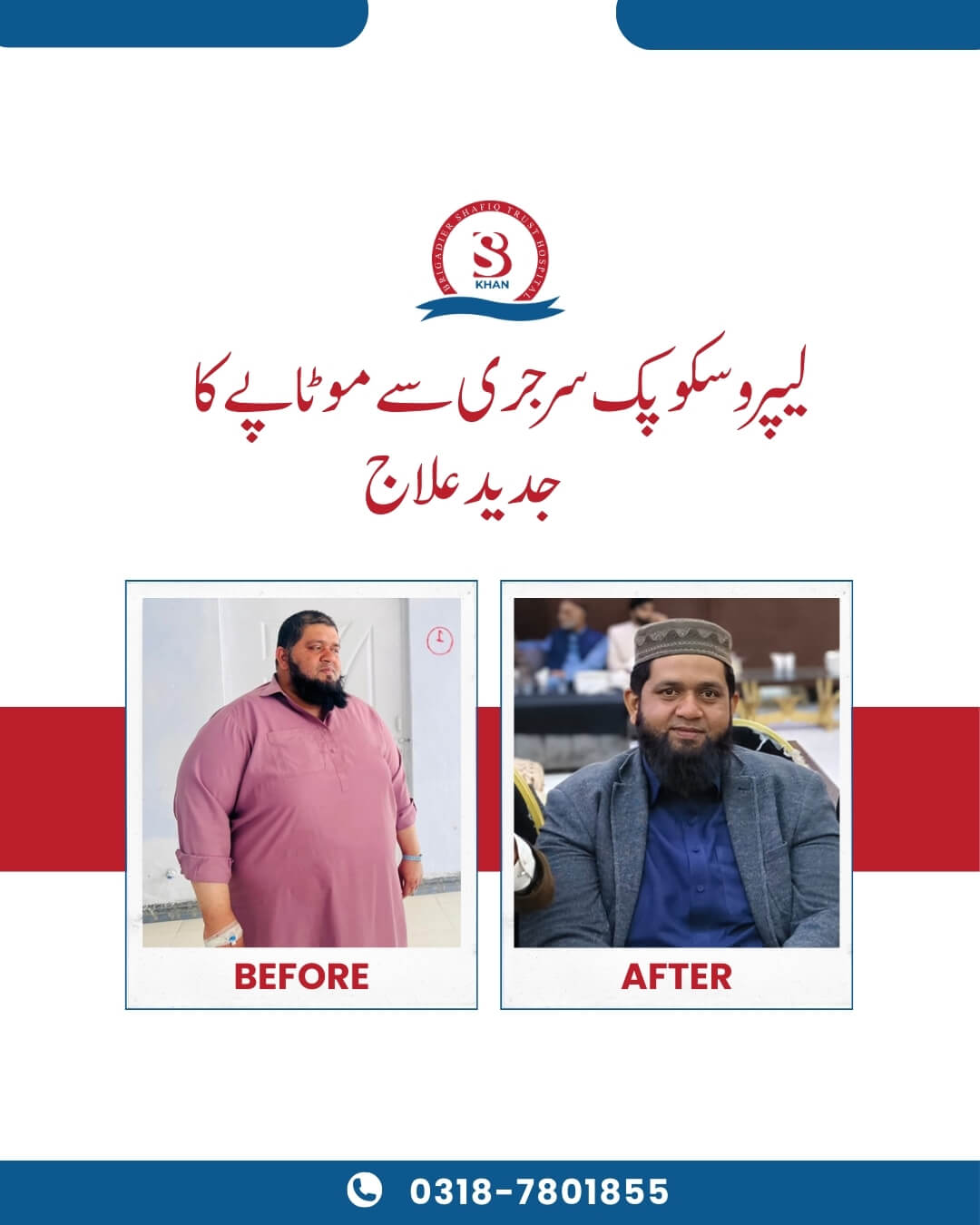 weight loss surgery before and after photos