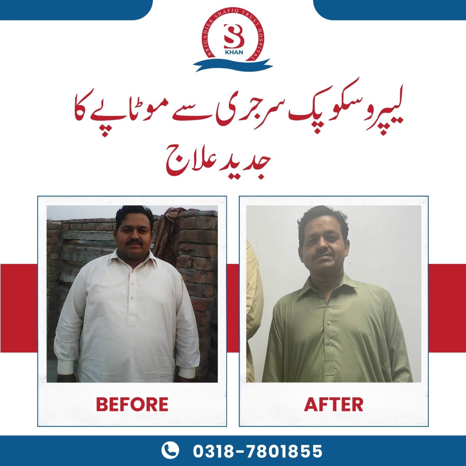 weight loss surgery before and after