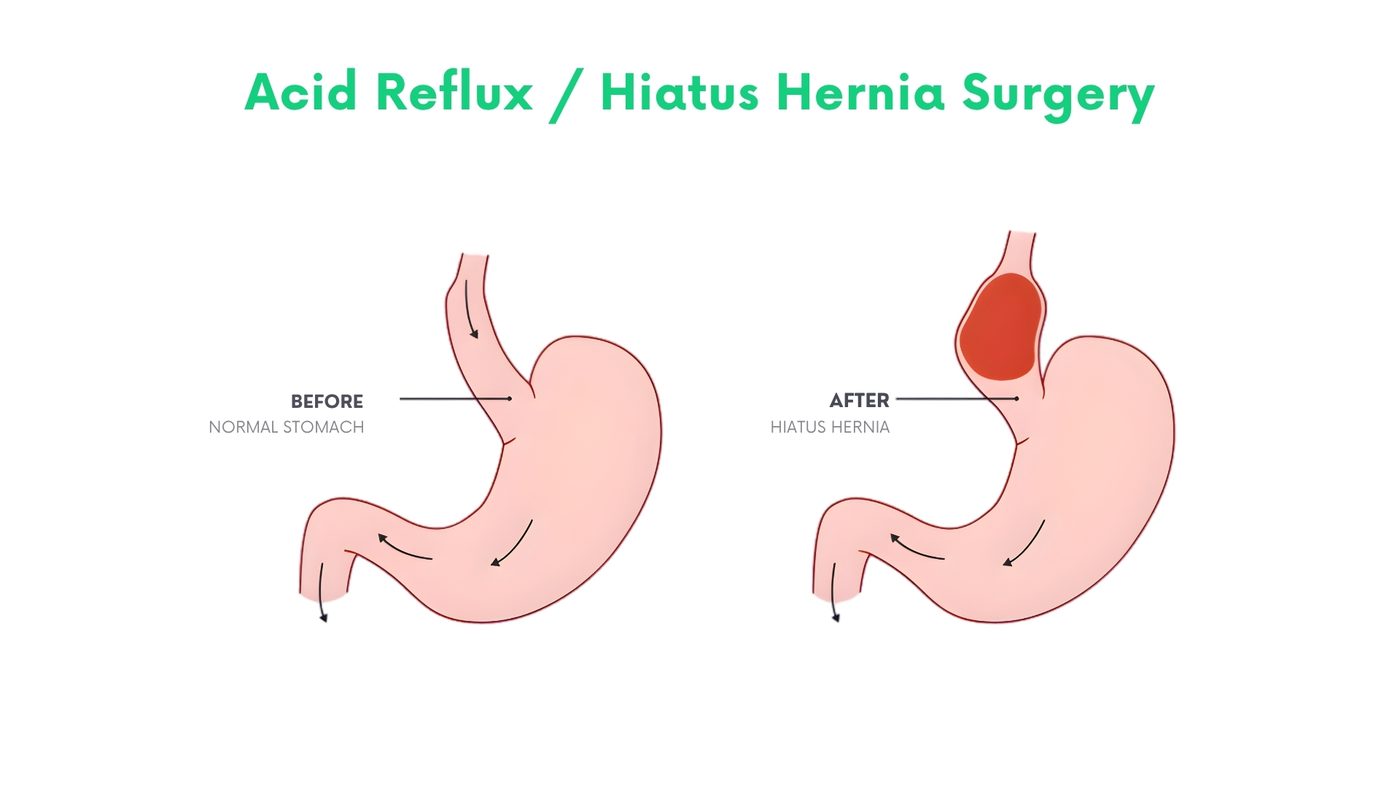 Acid Reflux Surgery in Bhakkar by Dr. Shehryar Niazi