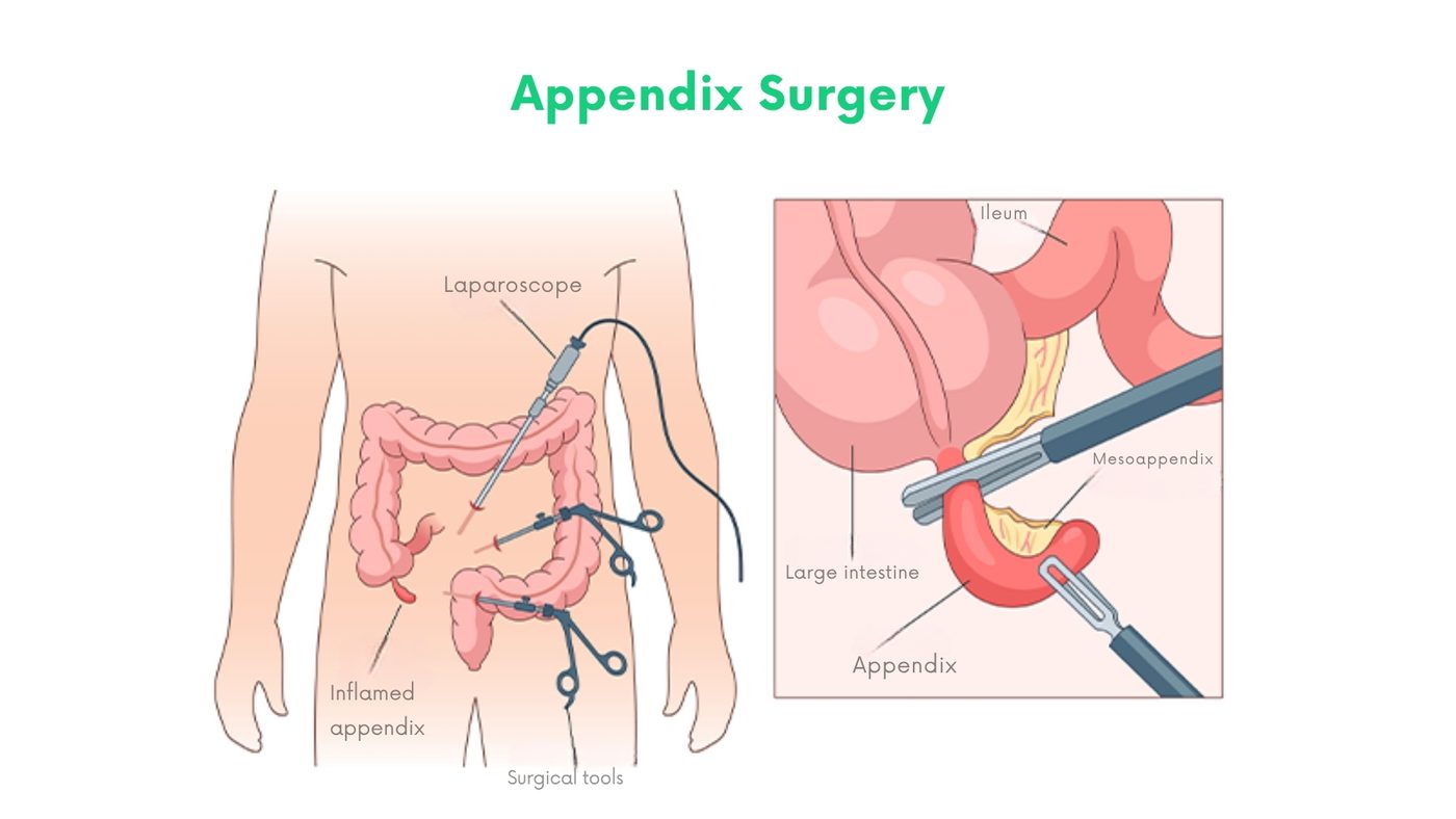 Appendix Surgery in Bhakkar by Dr. Shehryar Niazi