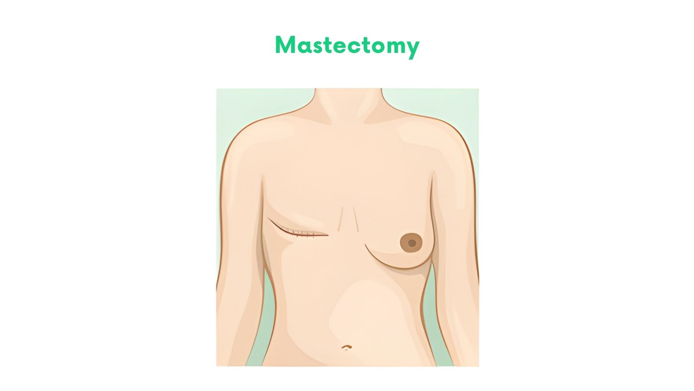 Breast Surgery in Bhakkar by Dr. Shehryar Niazi