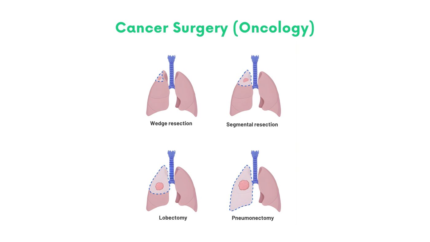 Cancer Surgery in Bhakkar by Dr. Shehryar Niazi