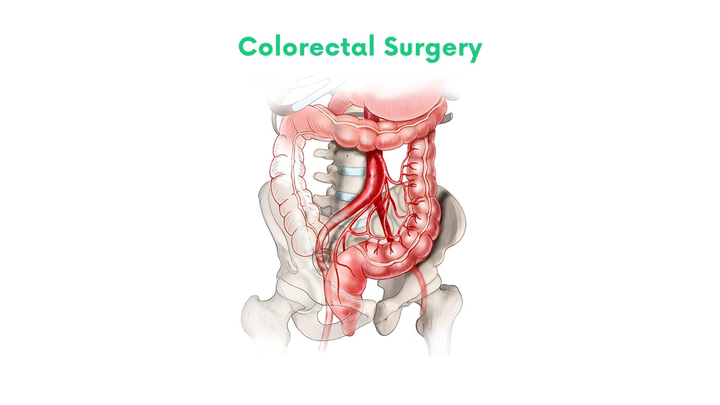 Colorectal Surgery in Bhakkar by Dr. Shehryar Niazi