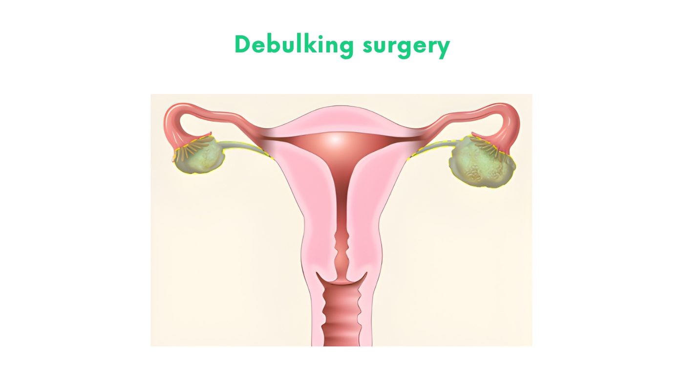 Debulking surgery (ovarian/peritoneal cancers) by Dr. Shehryar Niazi