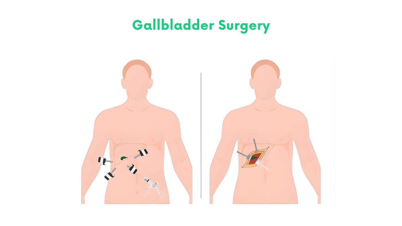 Gallbladder Surgery in Bhakkar by Dr. Shehryar Niazi