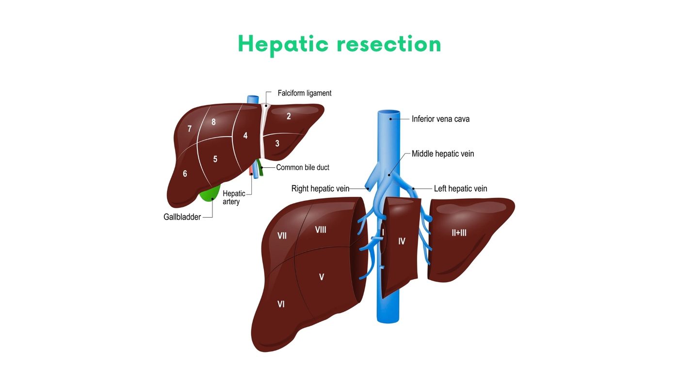 Hepatic resection (segmentectomy, lobectomy) in Lahore by Dr. Shehryar Niazi