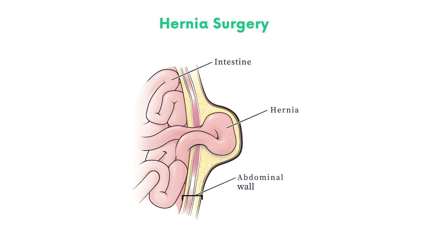 Hernia Surgery in Bhakkar by Dr. Shehryar Niazi