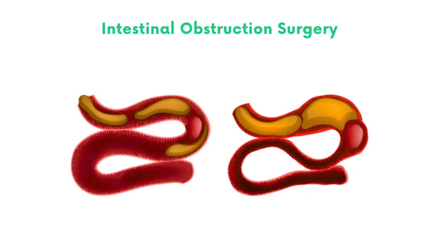 Intestinal Obstruction Surgery in Bhakkar by Dr. Shehryar Niazi
