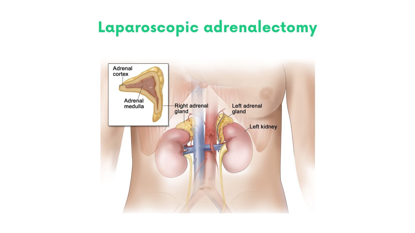 Laparoscopic adrenalectomy in Lahore by Dr. Shehryar Niazi