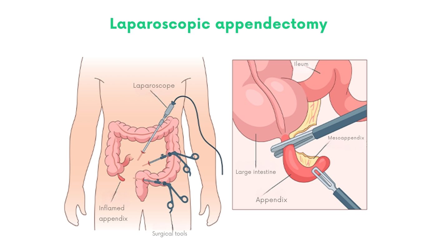 Laparoscopic appendectomy in Lahore by Dr. Shehryar Niazi