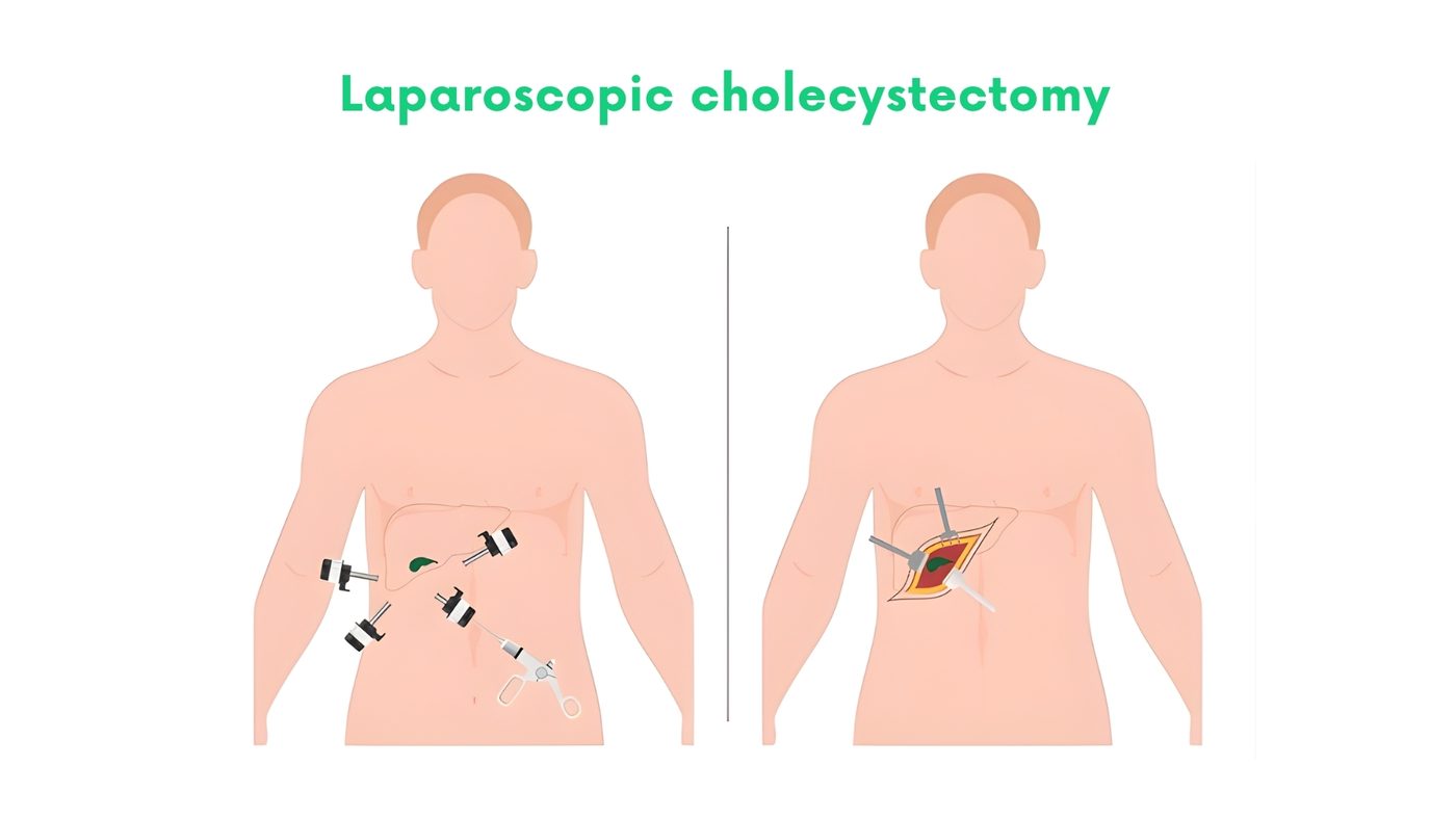 Laparoscopic cholecystectomy (gallbladder removal) in Lahore by Dr. Shehryar Niazi