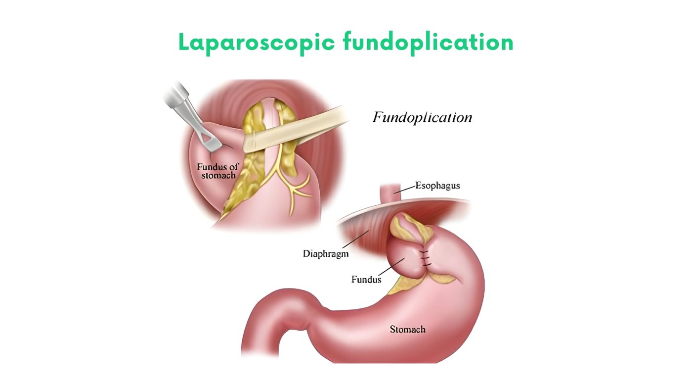 Laparoscopic fundoplication (GERD, hiatus hernia) in Lahore by Dr. Shehryar Niazi
