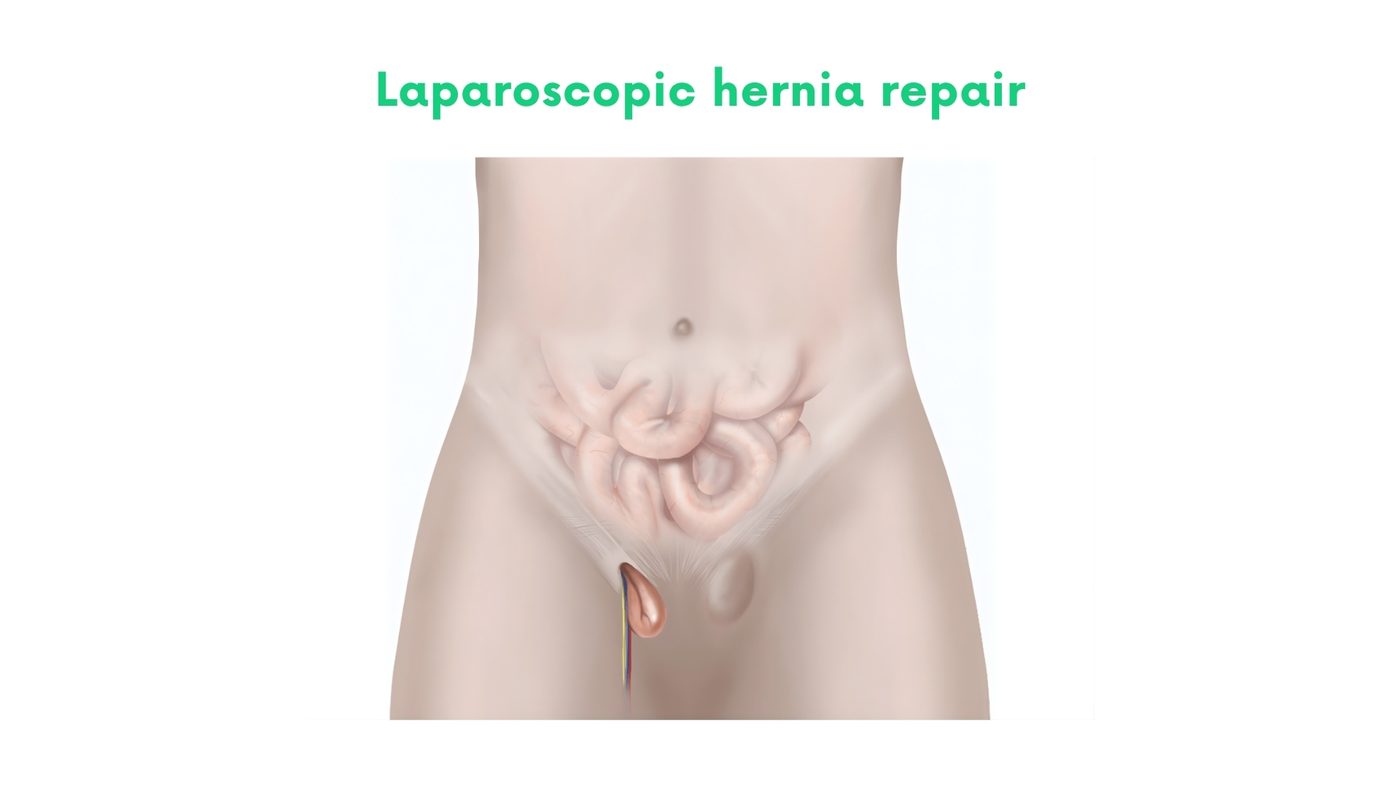 Laparoscopic hernia repair (inguinal TAPP/TEP, ventral/incisional IPOM) by Dr. Shehryar Niazi