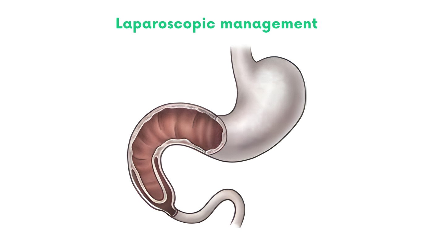 Laparoscopic management of intestinal obstruction in Lahore by Dr. Shehryar Niazi