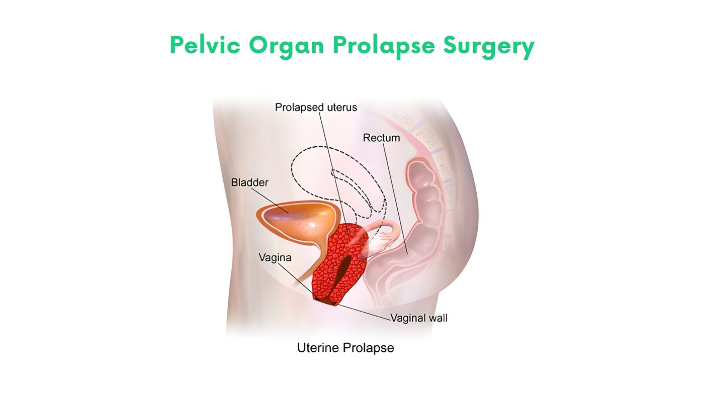 Laparoscopic pelvic organ prolapse surgery (uterus, bladder, rectal prolapse) in Bhakkar by Dr. Shehryar Niazi