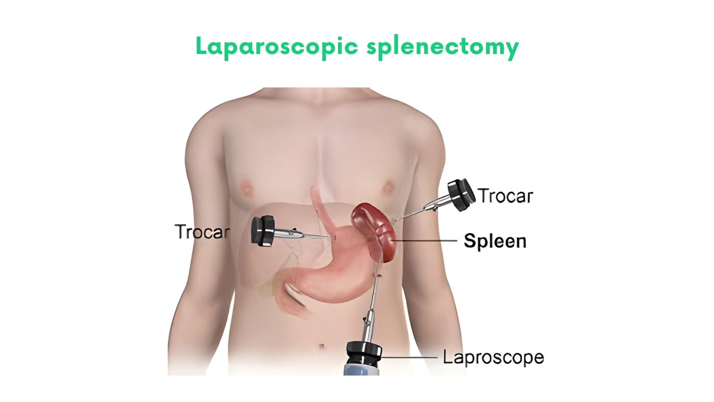 Laparoscopic splenectomy in Lahore by Dr. Shehryar Niazi