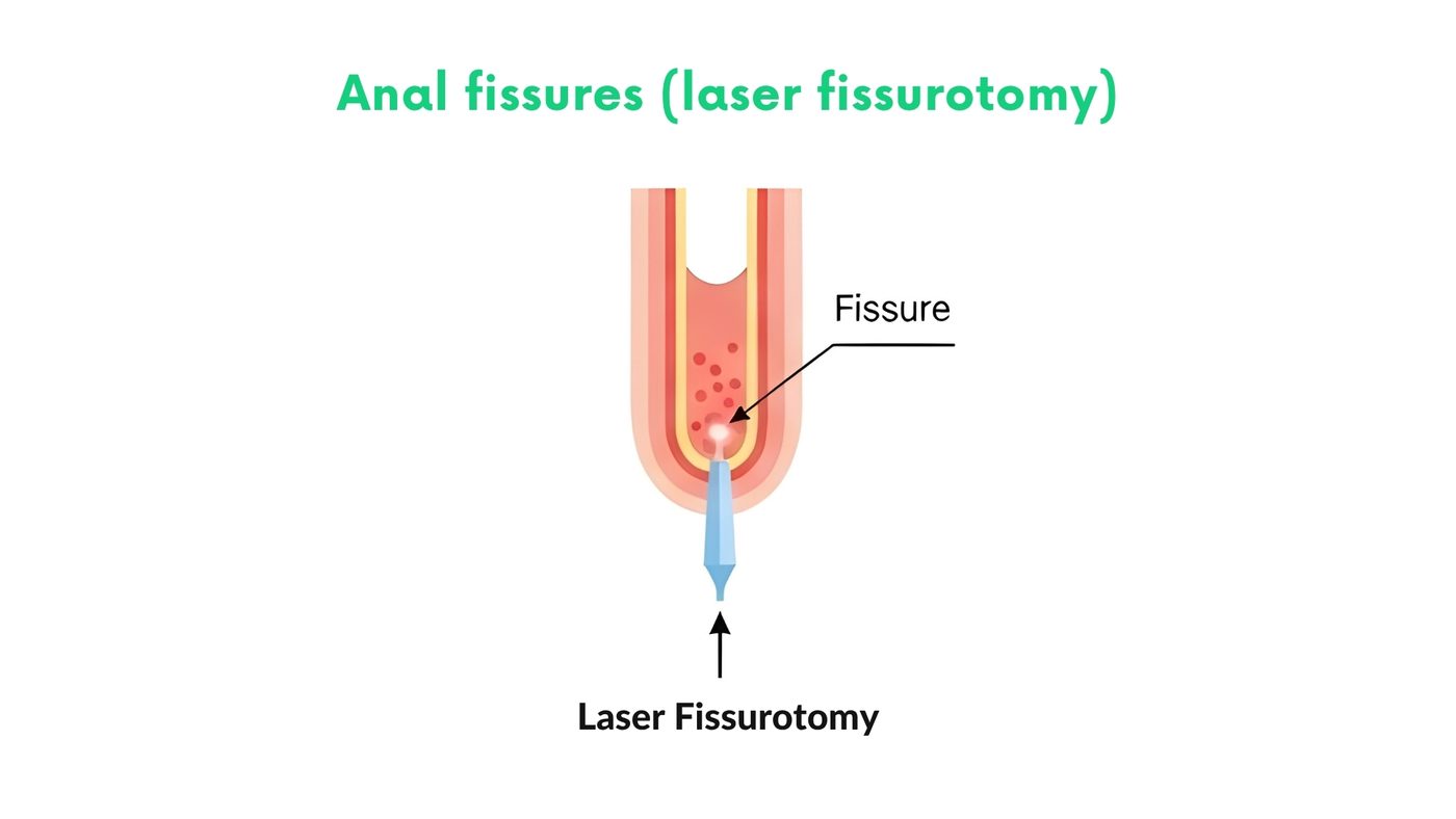 Anal fissures (laser fissurotomy) by Dr. Shehryar Niazi