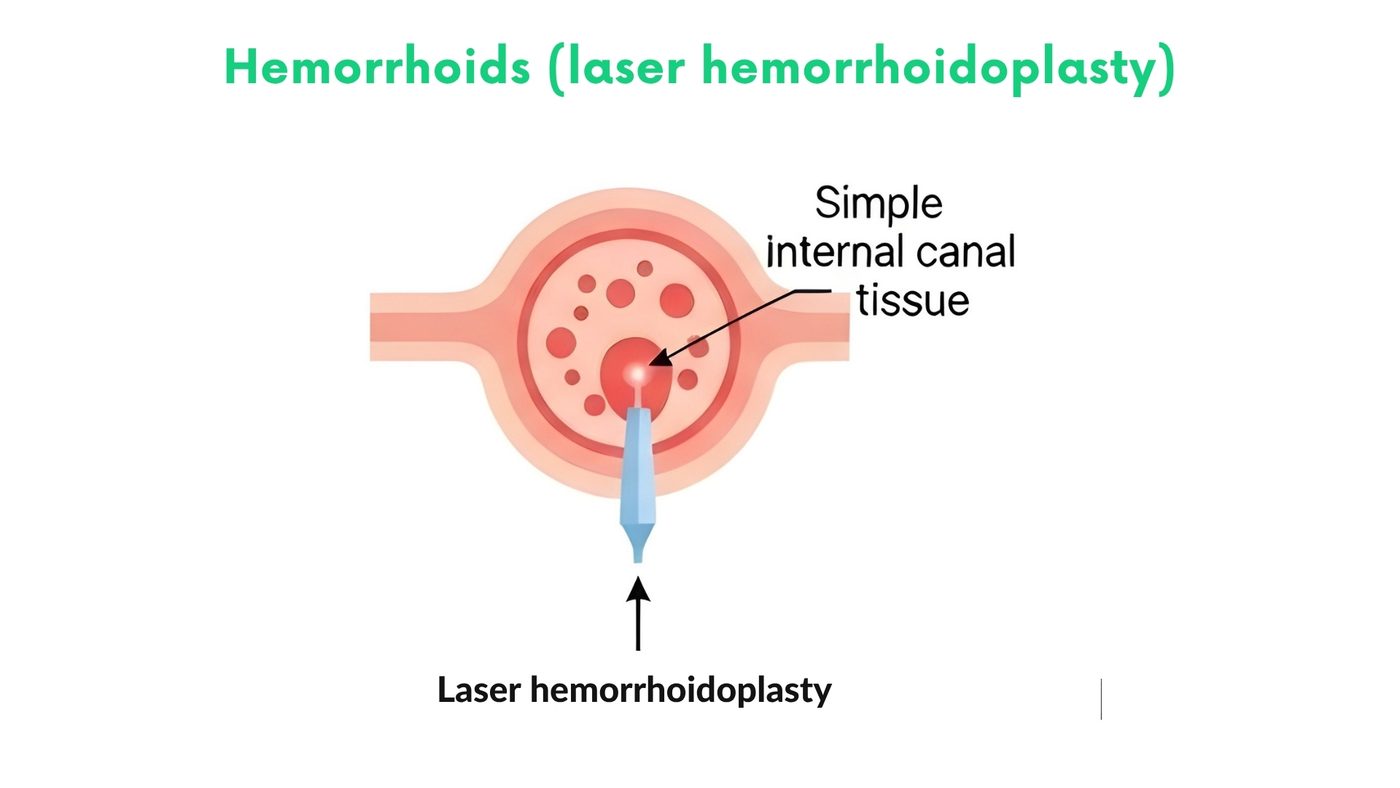 Hemorrhoids (laser hemorrhoidoplasty) by Dr. Shehryar Niazi