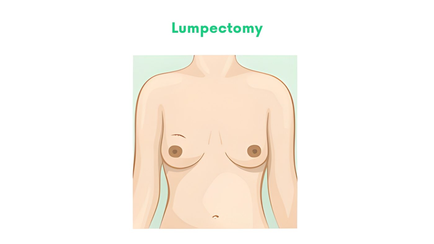 Lumpectomy by Dr. Shehryar Niazi