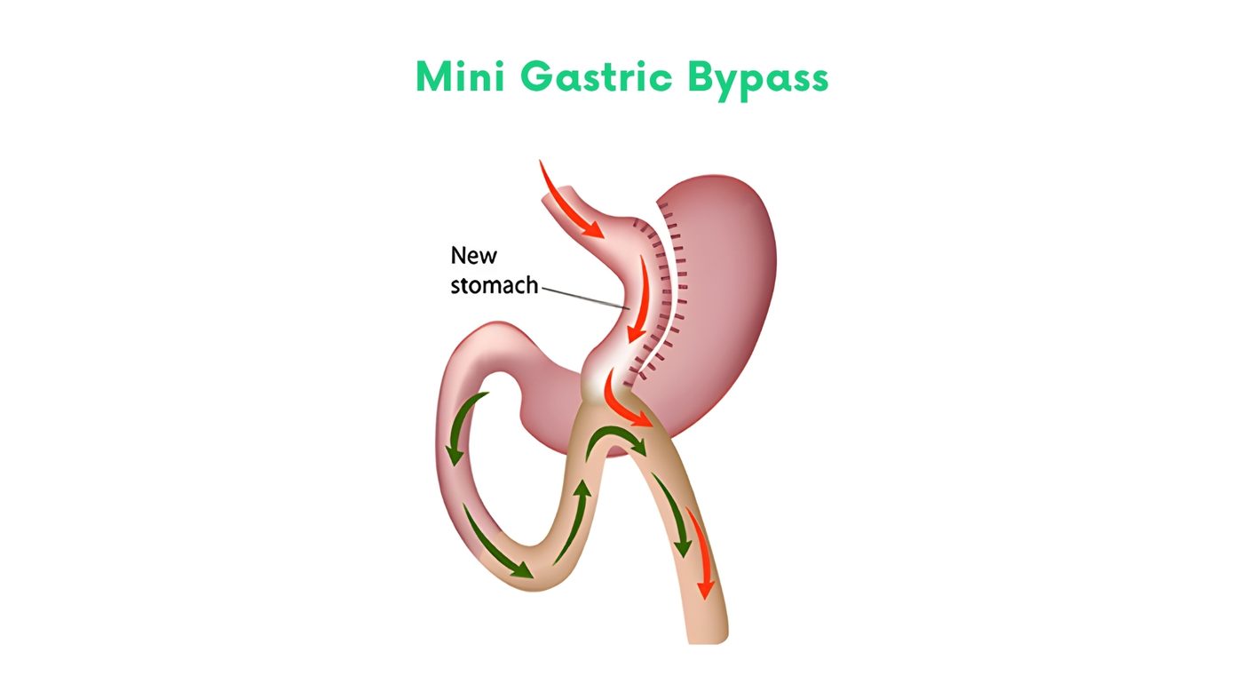 Laparoscopic mini gastric bypass (one-anastomosis gastric bypass) by Dr. Shehryar Niazi