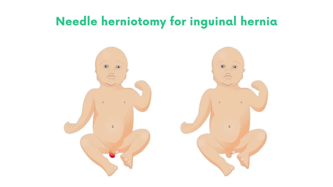 Needle herniotomy for inguinal hernia (children) in Lahore by Dr. Shehryar Niazi