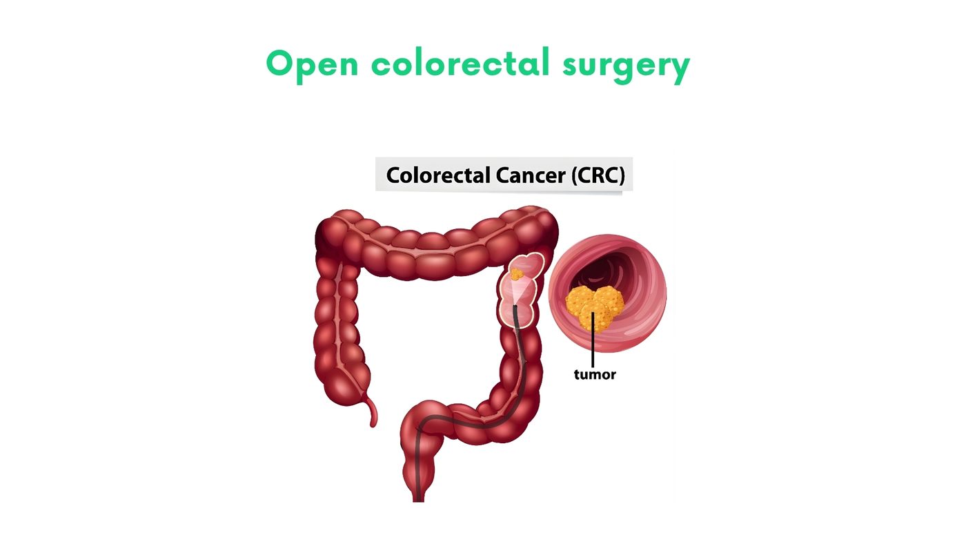 Open colorectal surgery (colectomy, proctocolectomy, APR, LAR) by Dr. Shehryar Niazi