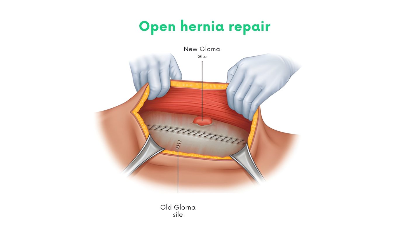 Open hernia repair (inguinal, umbilical, incisional) by Dr. Shehryar Niazi