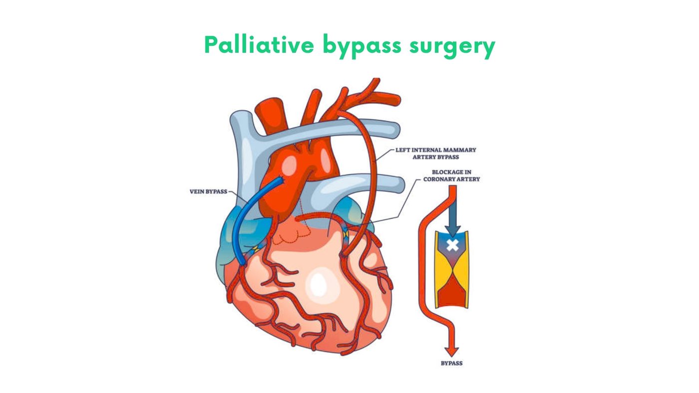 Palliative bypass surgery (gastric or biliary bypass) by Dr. Shehryar Niazi