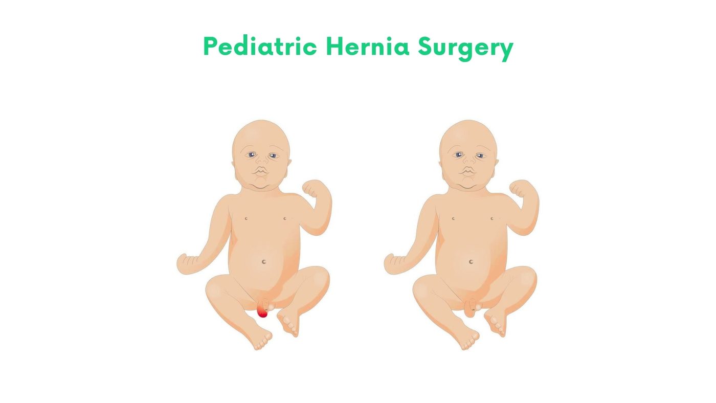 Pediatric Hernia Surgery in Bhakkar by Dr. Shehryar Niazi
