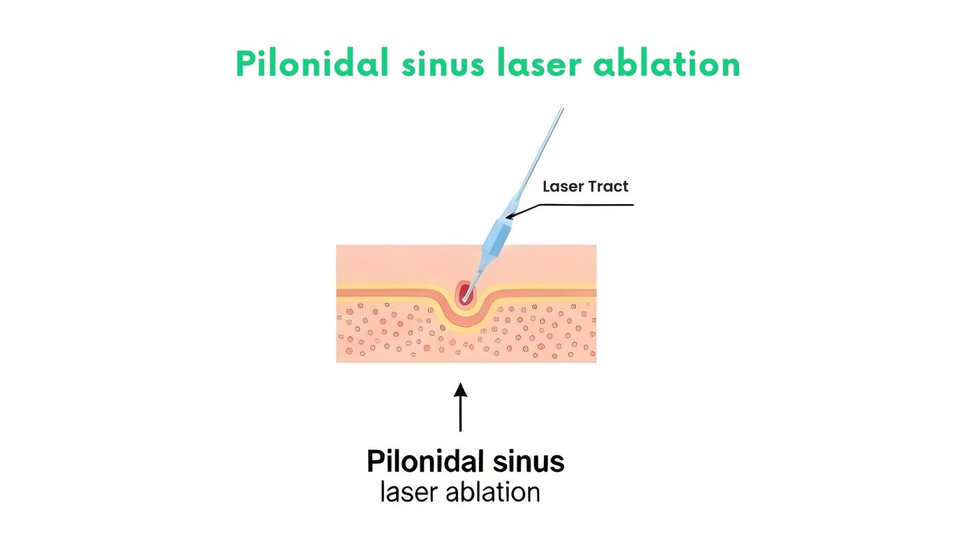Pilonidal sinus laser ablation by Dr. Shehryar Niazi