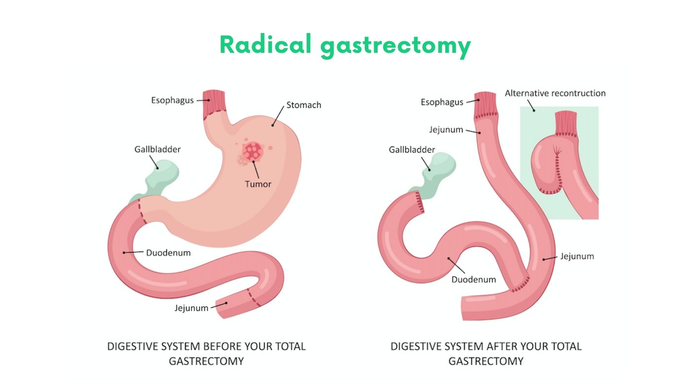 Radical gastrectomy (stomach cancer) by Dr. Shehryar Niazi