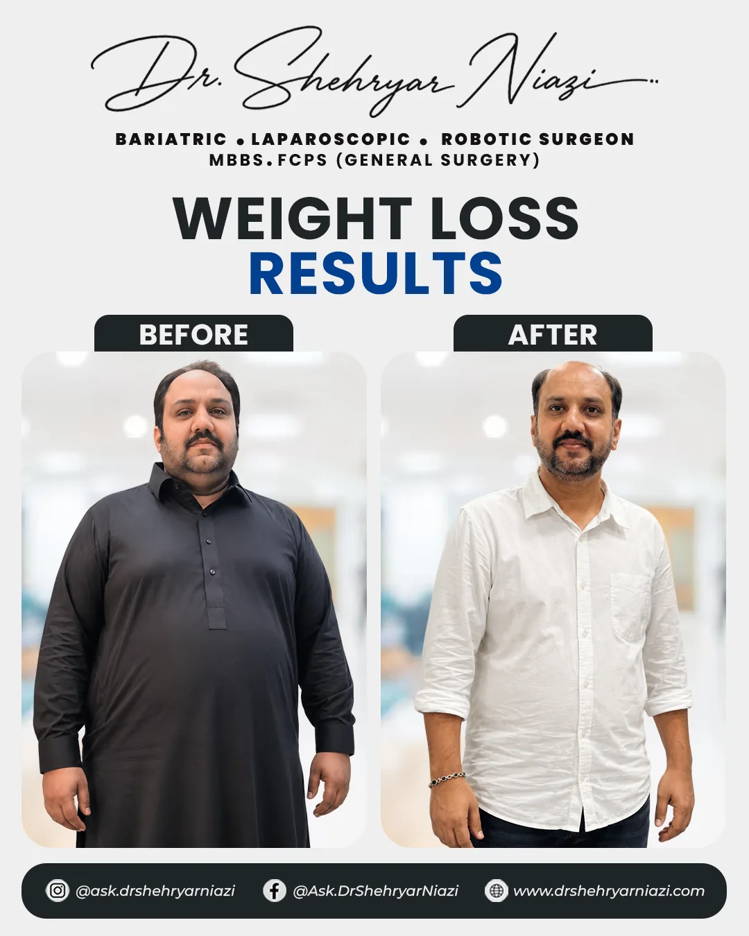 Weight loss surgery before and after result 1, bariatric patient of Dr. Shehryar Niazi