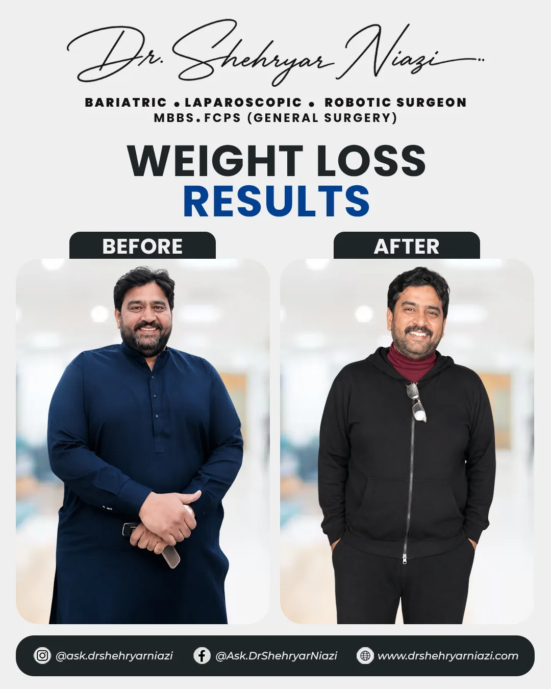 Weight loss surgery before and after result 5, bariatric patient of Dr. Shehryar Niazi