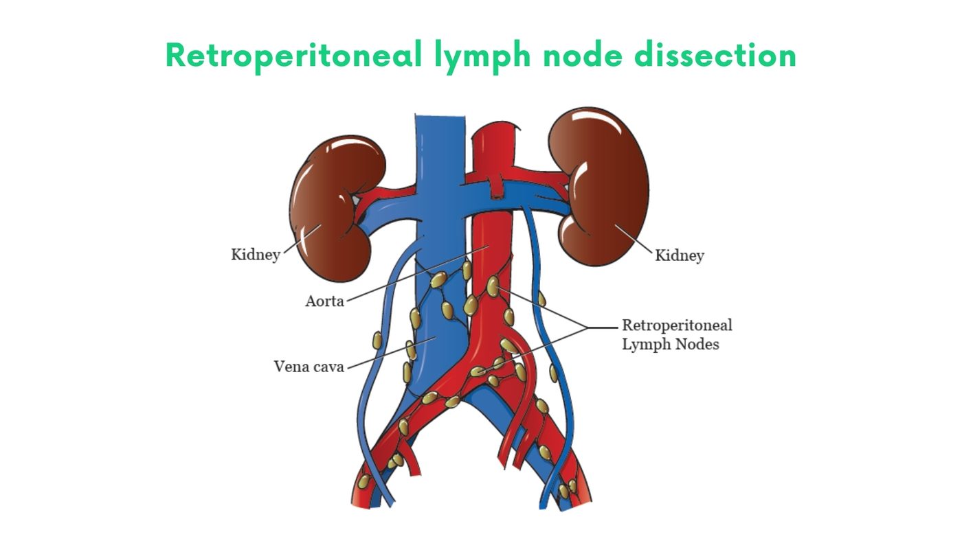 Retroperitoneal lymph node dissection (RPLND) in Lahore by Dr. Shehryar Niazi