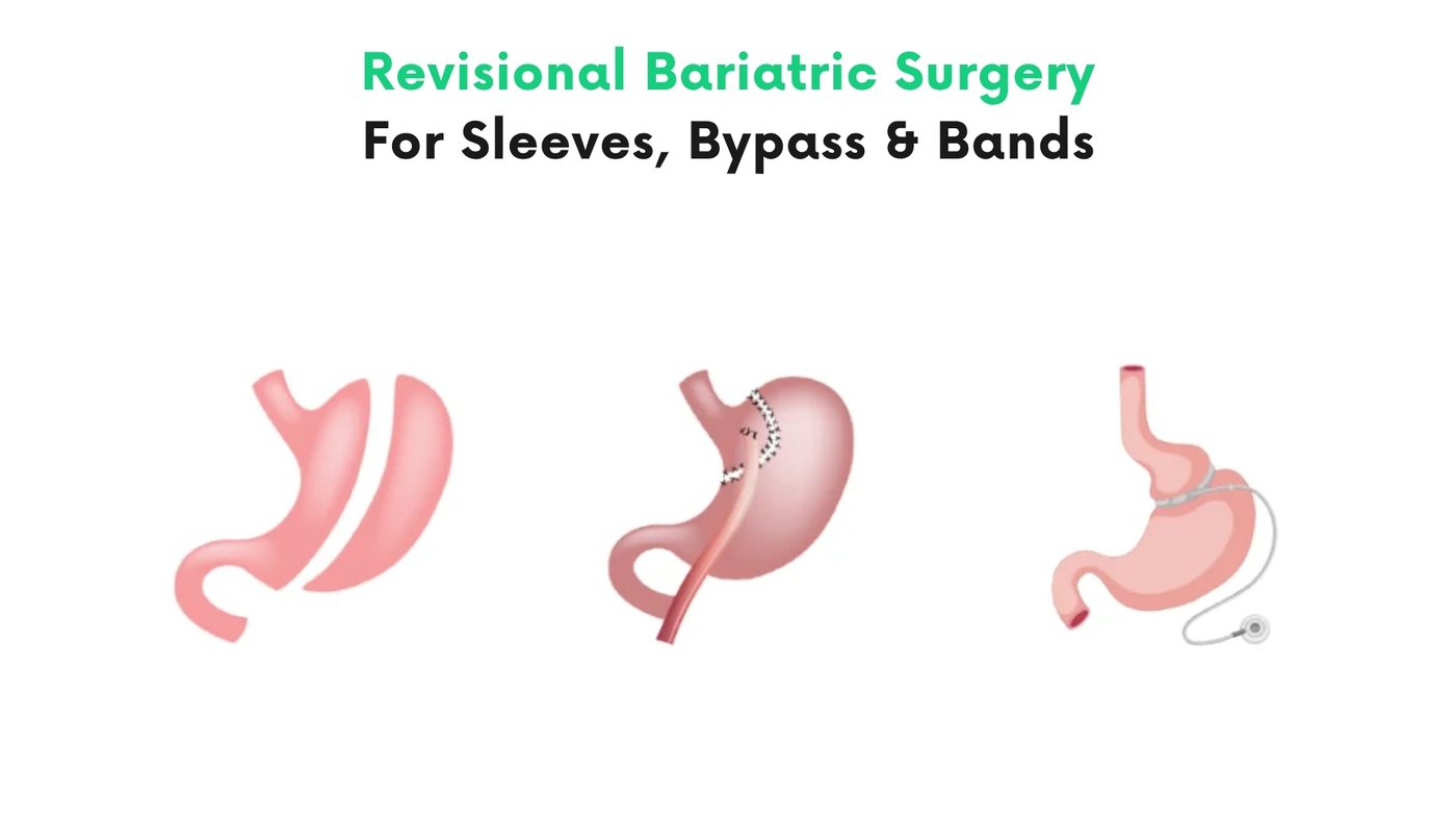 Revisional bariatric surgery (band→sleeve/bypass, sleeve→bypass) by Dr. Shehryar Niazi