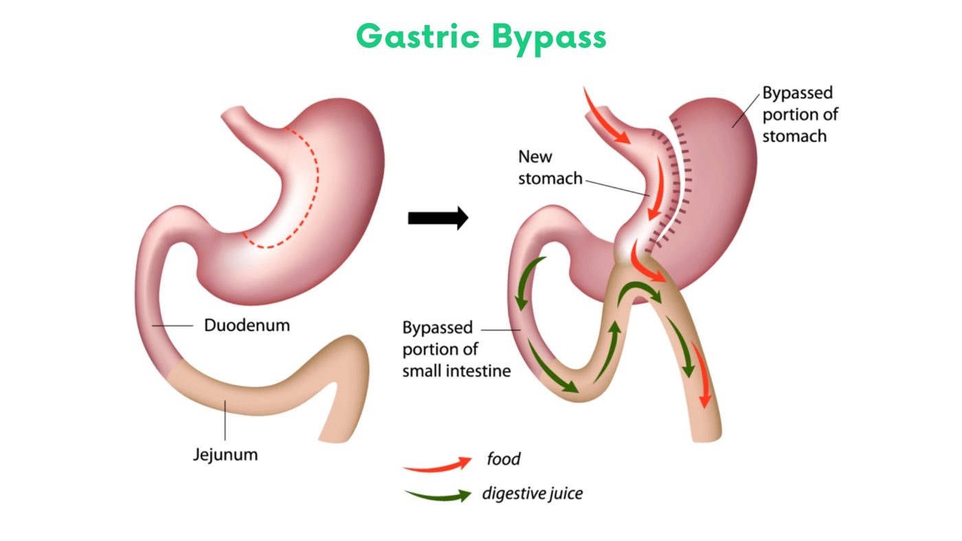 Laparoscopic Roux-en-Y gastric bypass by Dr. Shehryar Niazi