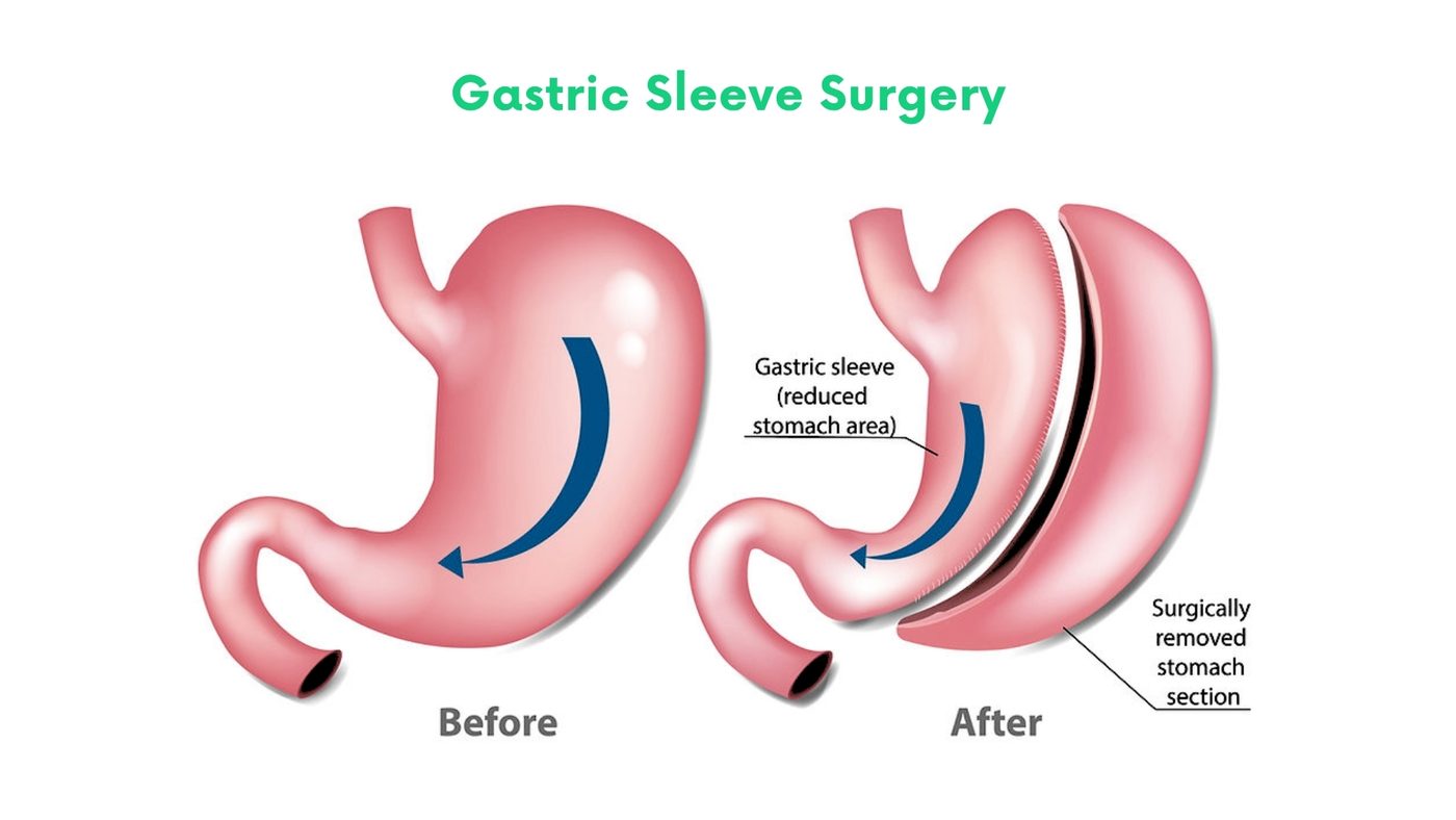 Laparoscopic sleeve gastrectomy by Dr. Shehryar Niazi