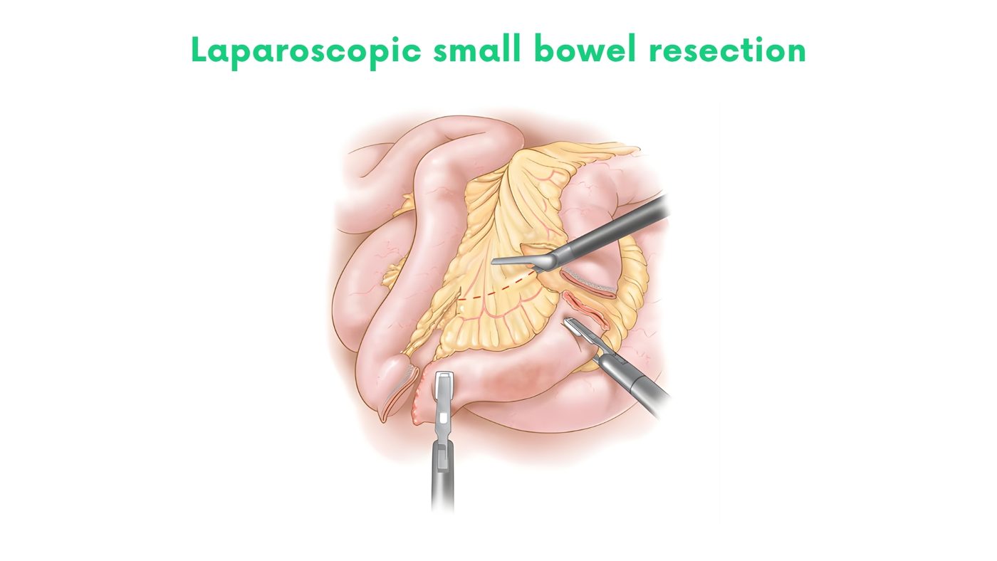 Laparoscopic small bowel resection and anastomosis in Lahore by Dr. Shehryar Niazi