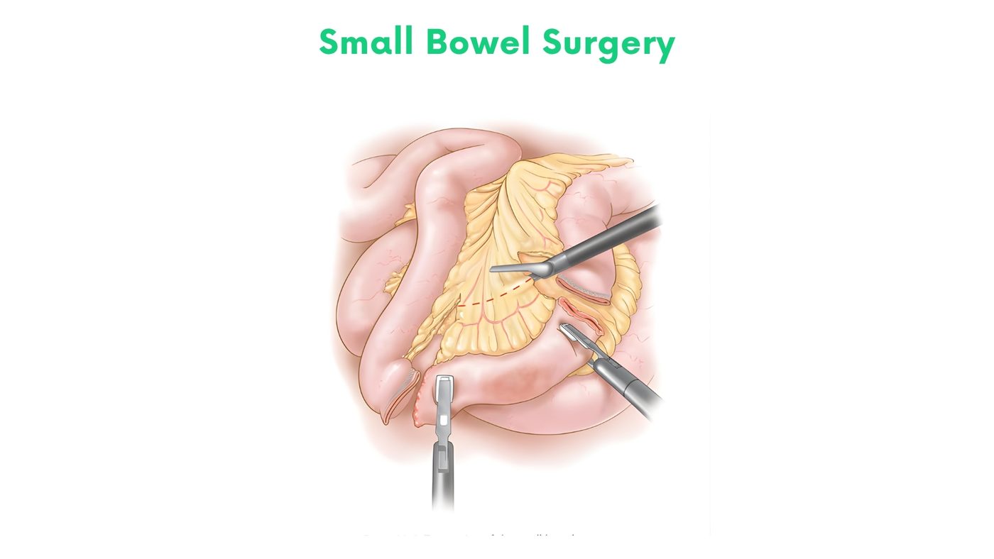 Small Bowel Surgery in Bhakkar by Dr. Shehryar Niazi