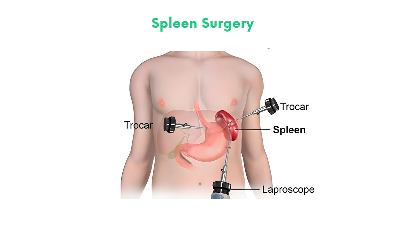 Spleen Surgery in Bhakkar by Dr. Shehryar Niazi