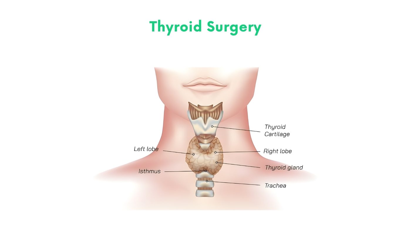 Thyroid Surgery in Bhakkar by Dr. Shehryar Niazi