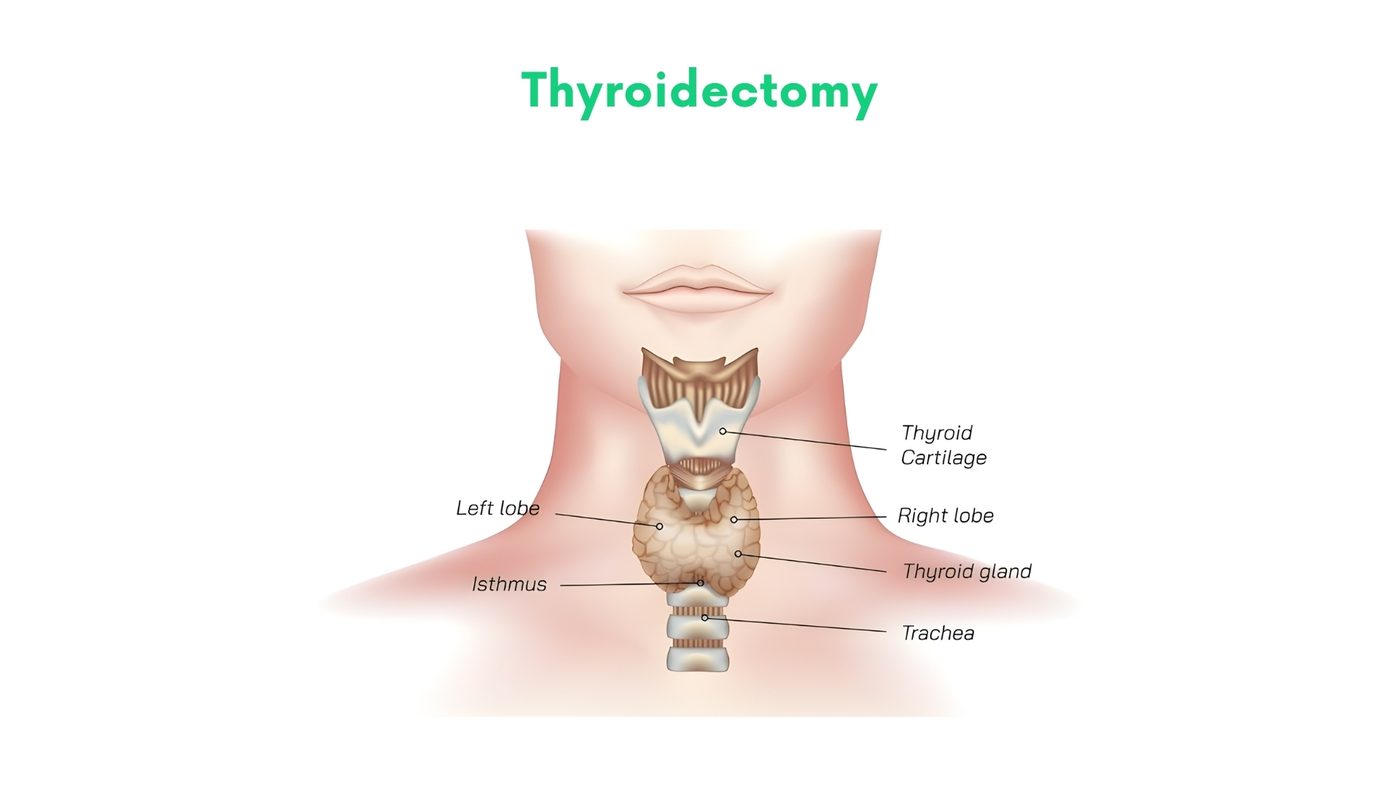 Thyroidectomy in Lahore by Dr. Shehryar Niazi